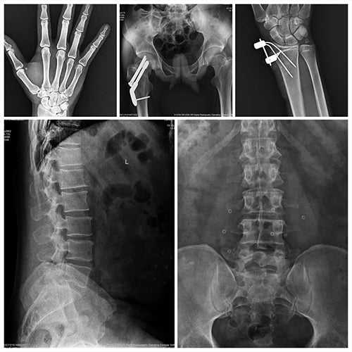 100mA HF Mobile X-Ray – SMART 4000