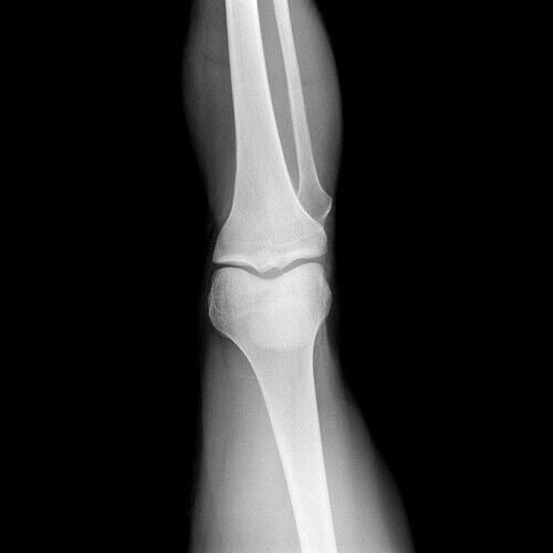 10mA Portable X-Ray