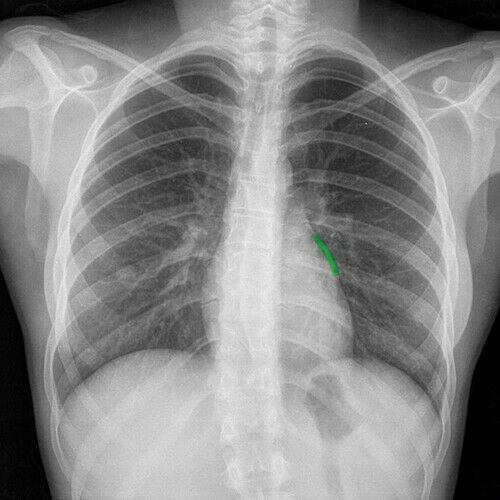10mA Portable X-Ray