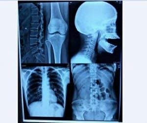 8" X 10" PET Inkjet Blue Medical Imaging Film 210 Micron (280 GSM) Thickness Waterproof (Pack of 100 Sheets)